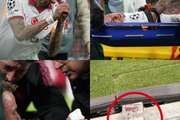 手指幸运保住!TA:诺阿·朗的大拇指不用截肢,但伤势严重